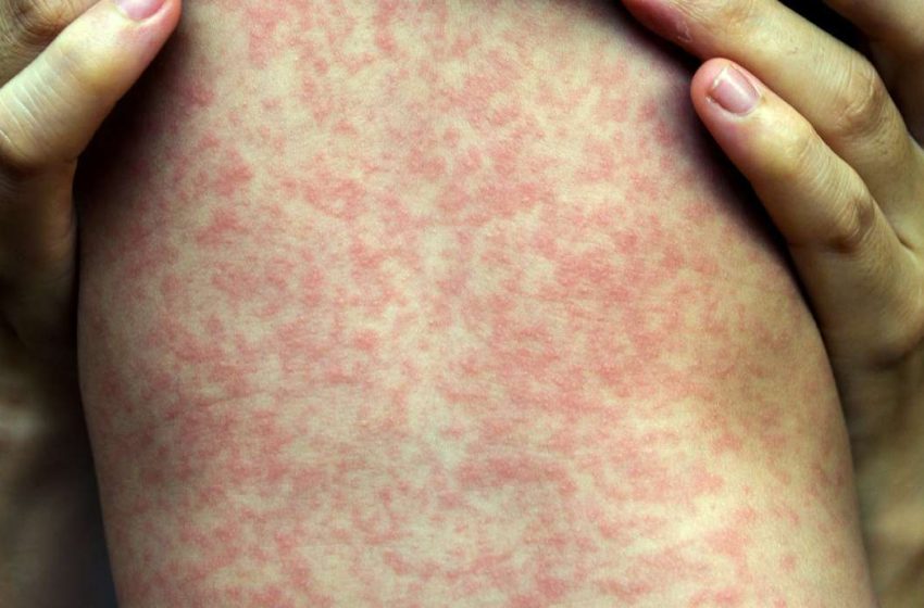  Multiple people at state wrestling tournament diagnosed with measles as it spreads in Utah