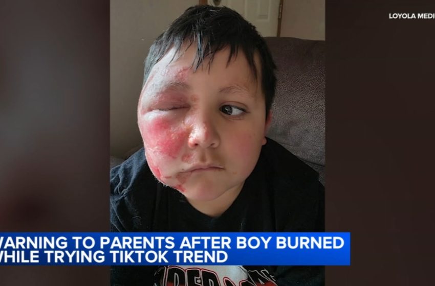  TikTok trend Needoh cube: Boy burned after social media trend; Loyola Medicine shares urgent warning