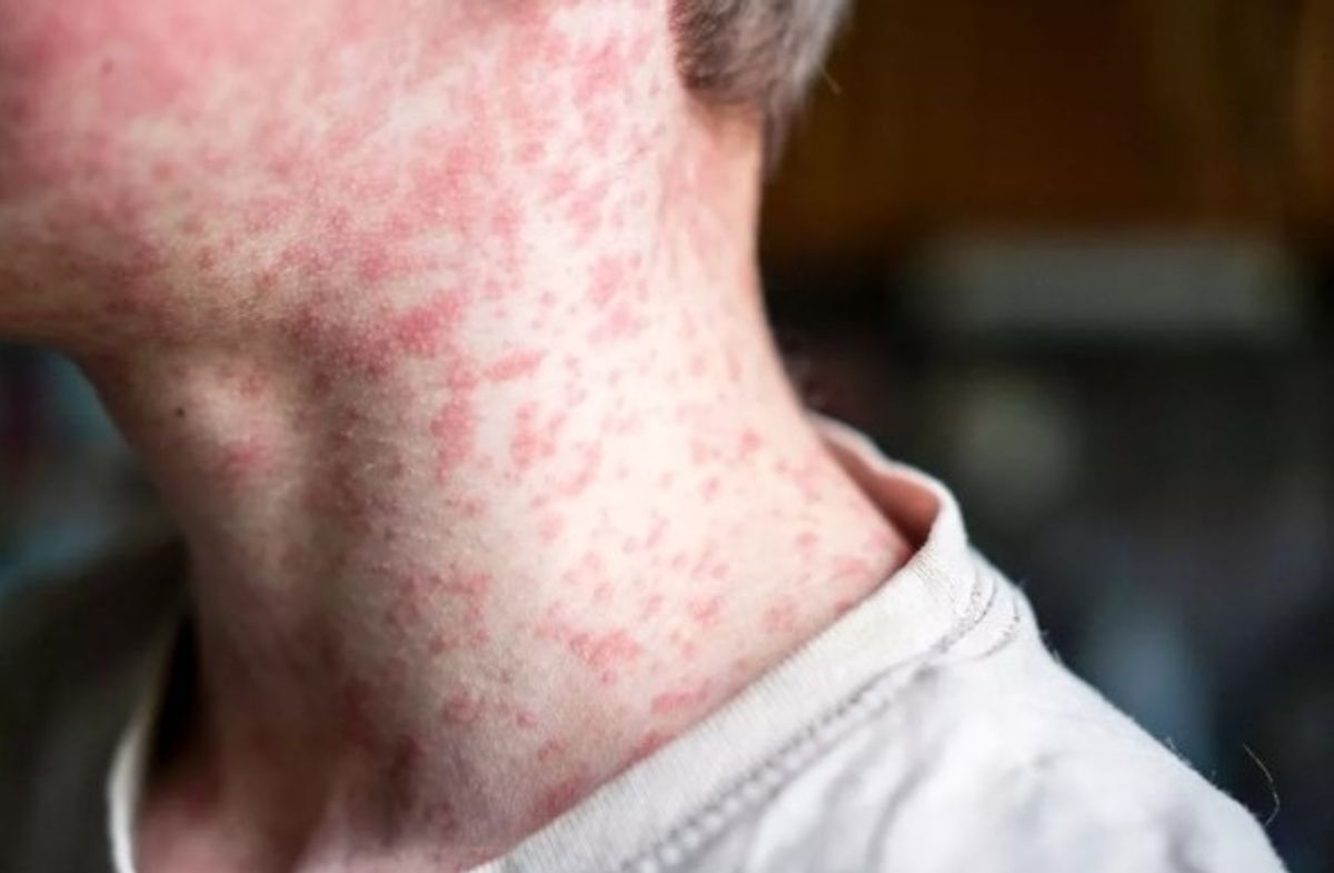 Measles rash