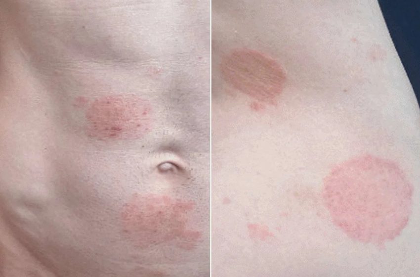  Sexually Transmitted Ringworm Hits Minnesota in ’Largest Known Outbreak’