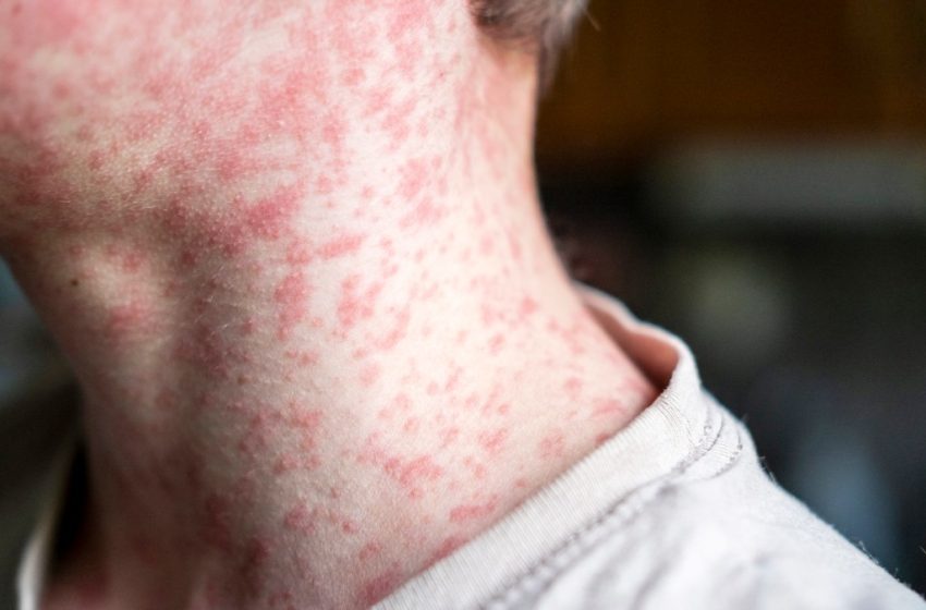  London measles outbreak: more than 60 children infected – The Times