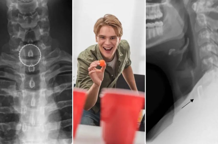  19-year-old’s bizarre beer pong injury required surgery to fix