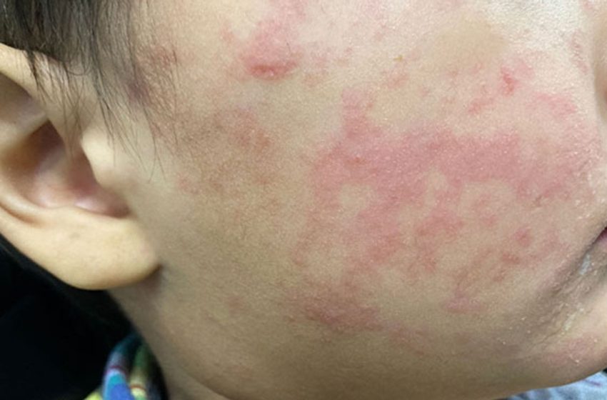  South Carolina measles outbreak tops 800; new numbers expected Tuesday