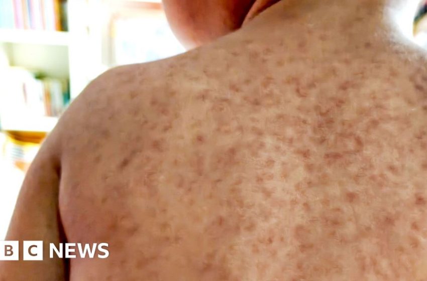  Unvaccinated pupils could be excluded from school as measles hits north London – BBC