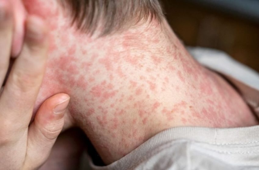  Unvaccinated child dies of complications from measles