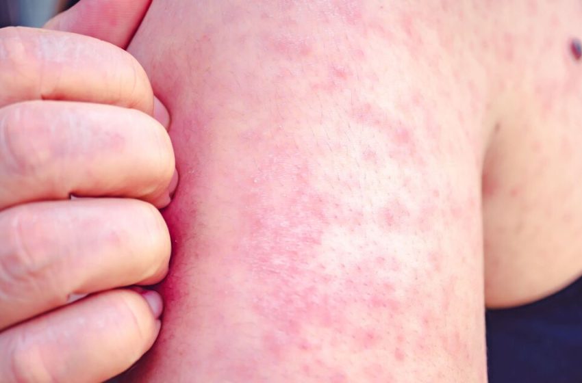  Victorian disease outbreak rocks major city sparking World Cup warning | World | News