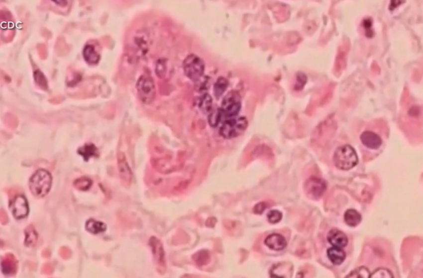  Over 50 cases of measles confirmed at Ave Maria University – WINK News