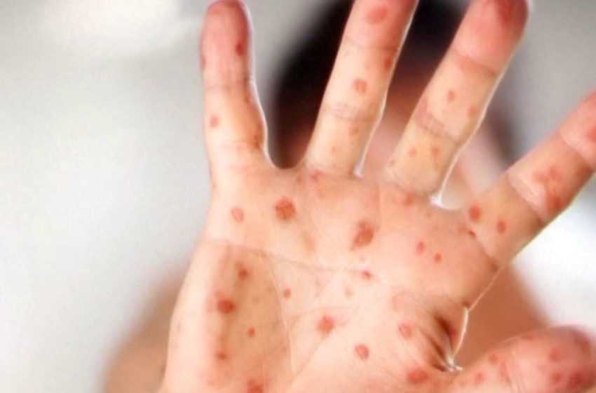  Measles exposure reported at Phoenix Sky Harbor International Airport