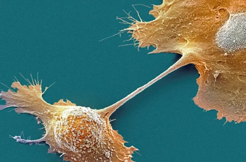  FDA Approves Pancreatic Cancer Device That Extends Survival From Israeli-founded Novocure