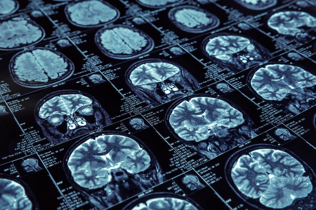 The combination reduced classic hallmarks of Alzheimer’s in the brain, researchers found. Nomad_Soul – stock.adobe.com