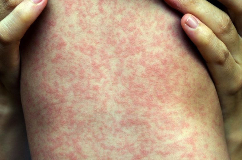  Measles Outbreak in South Carolina Linked to Brain Swelling in Kids