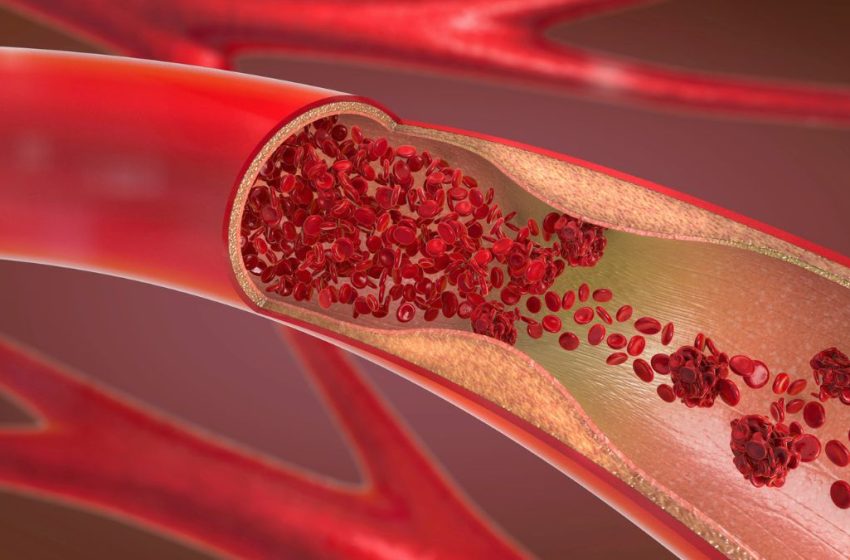  ‘Remnant’ Cholesterol Cut by More Than 60 Percent in New Drug Trial : ScienceAlert