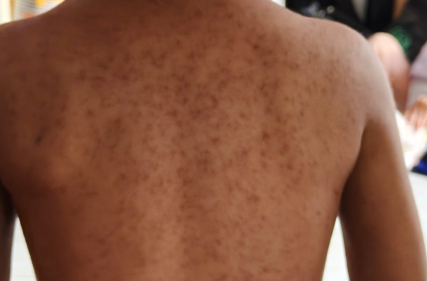  Health officials warn of possible measles exposure at Pa. urgent care center