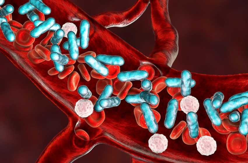  Newlywed dies from sepsis. What is it?