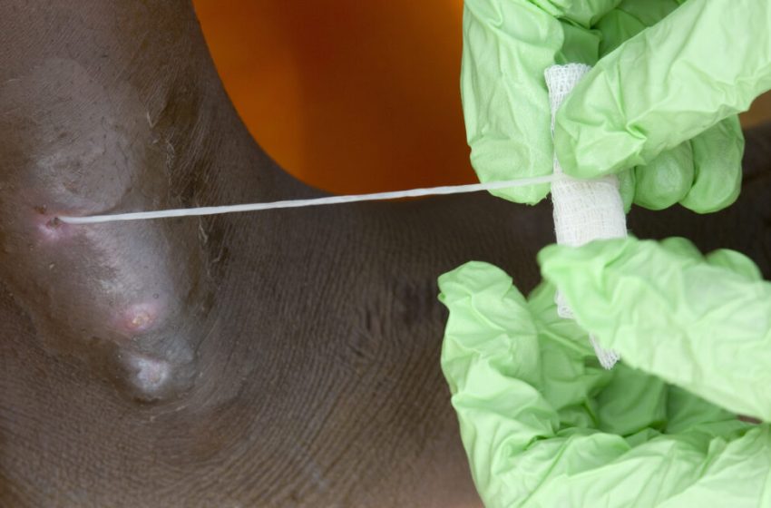  Guinea worm on track to be 2nd eradicated human disease; only 10 cases in 2025