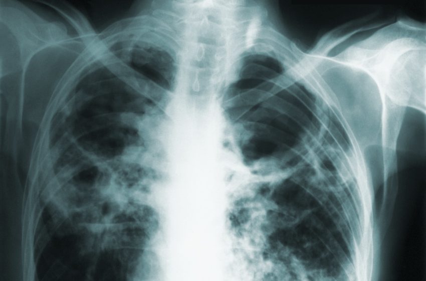  Camden County resident in isolation after testing positive for tuberculosis