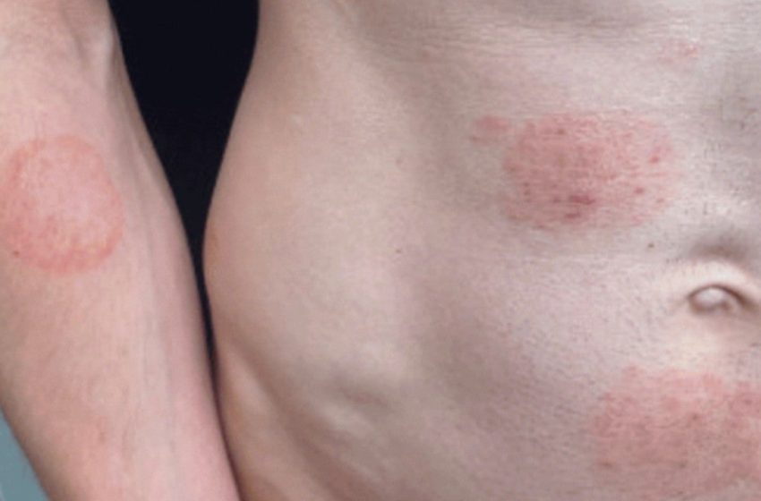  Nation’s ‘largest known outbreak’ of sexually transmitted ringworm fungus in Minnesota