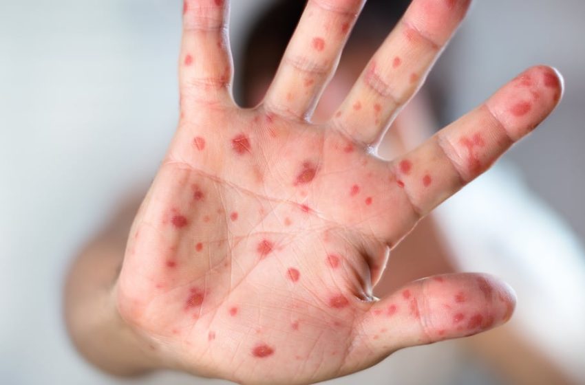  Measles exposure site identified at medical center in Oregon City, OHA says