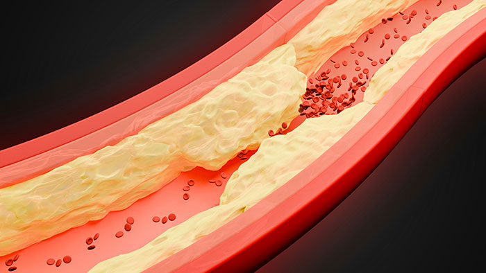 3D illustration of a clogged artery with plaque buildup showing blood flow blockage and health risks concept.