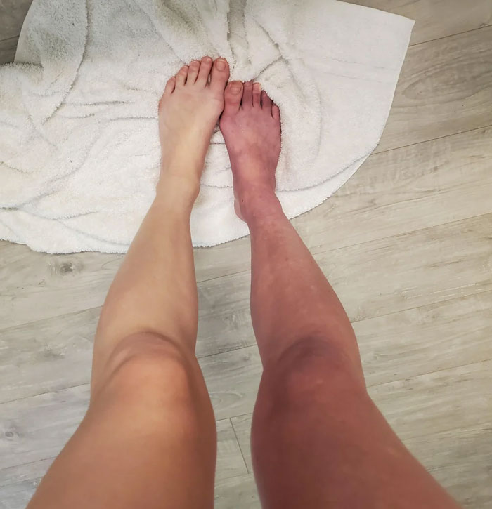 One leg with a natural skin tone and the other leg unusually red, highlighting a weirdly hilarious image contrast.