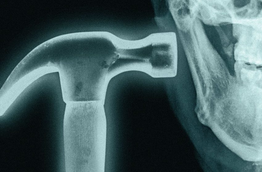  What is Bonesmashing? Inside the Extreme Looksmaxxer Technique