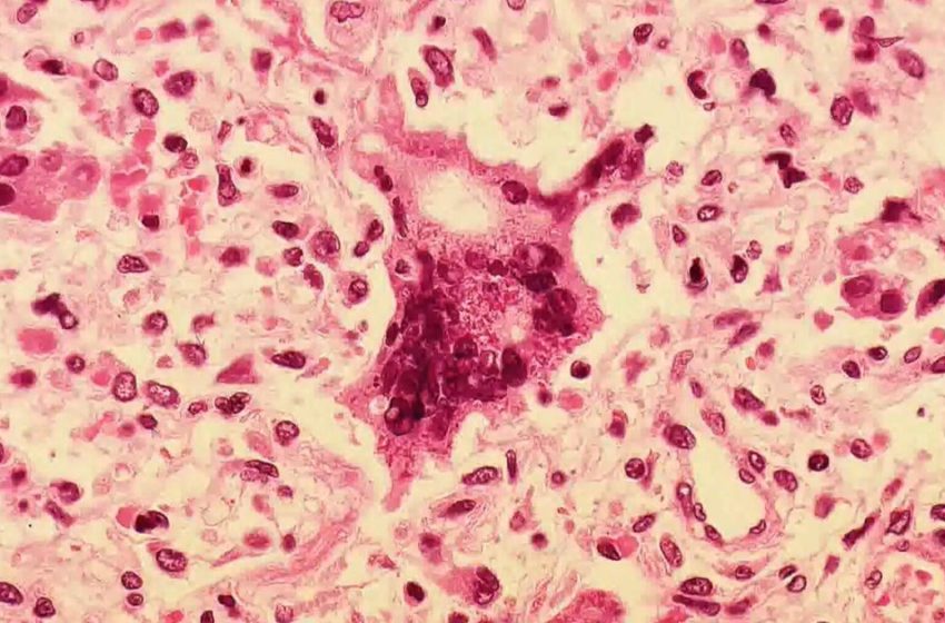  Person with measles visited car dealership and Wawa in Montgomery County, Pennsylvania health officials say