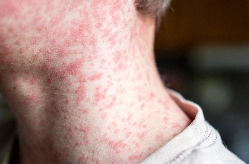  Second measles case connected to Disneyland visitor reported by Orange County officials