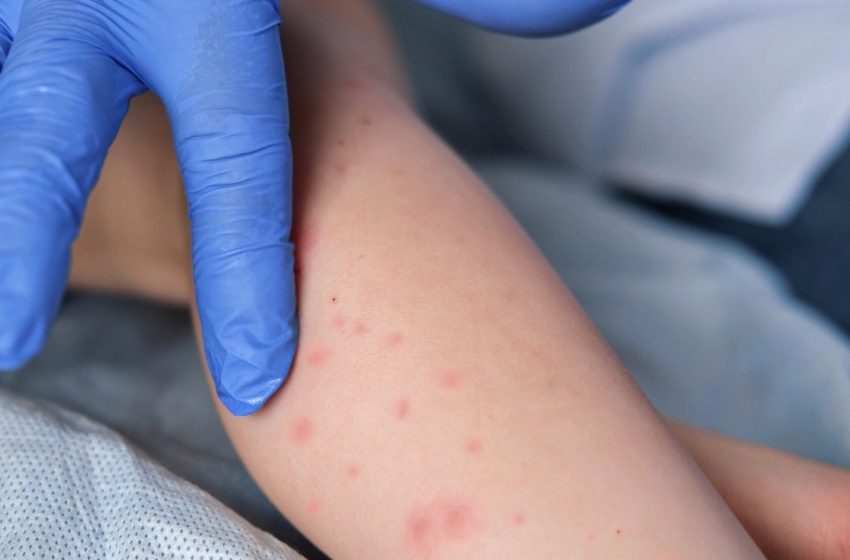  Measles case confirmed in Pensacola area