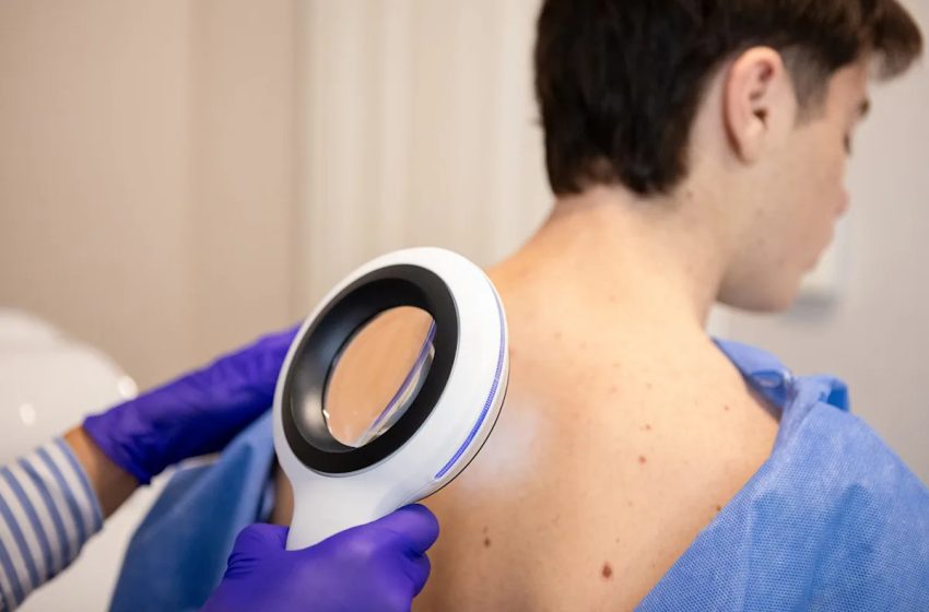  Sexually transmitted ringworm is spreading in this state, officials warn