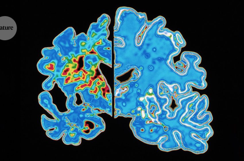  Blood test holds promise for predicting when Alzheimer’s symptoms will start