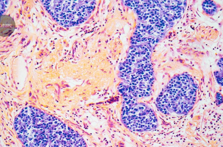  Are obesity drugs causing a severe complication? What the science says