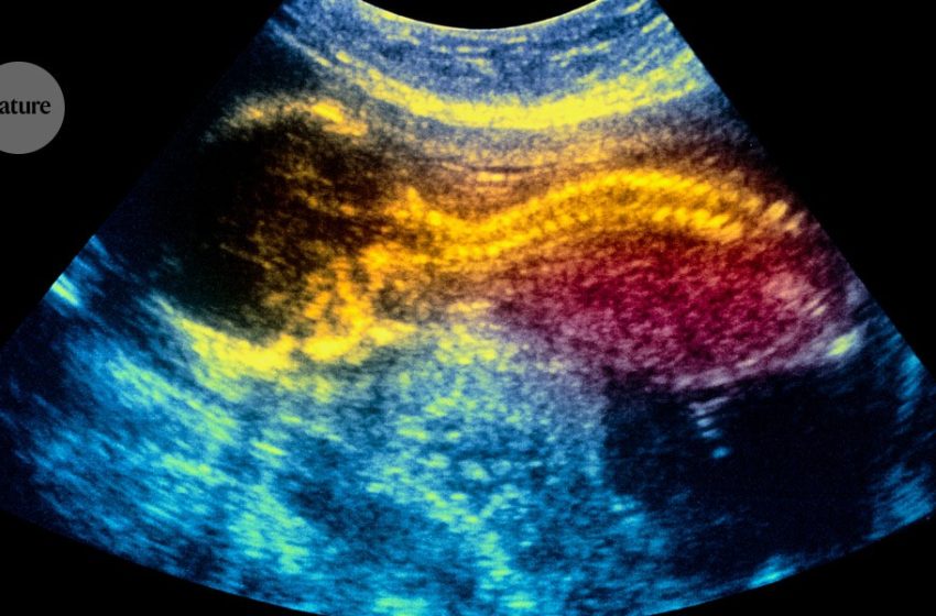  World-first stem-cell therapy shows promise for treating spina bifida in the womb