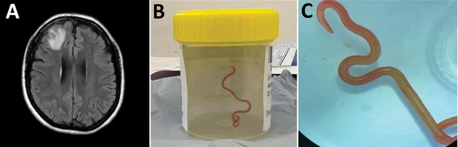 Detection Of Ophidascaris Robertsi Nematode Infection In A 64 Year Old Woman From Southeastern New South Wales