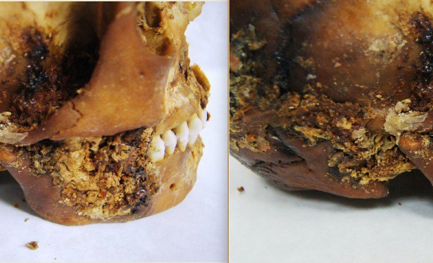  2,500-year-old ‘primitive prosthetic’ found on jaw of mummified Scythian woman who survived complex jaw surgery