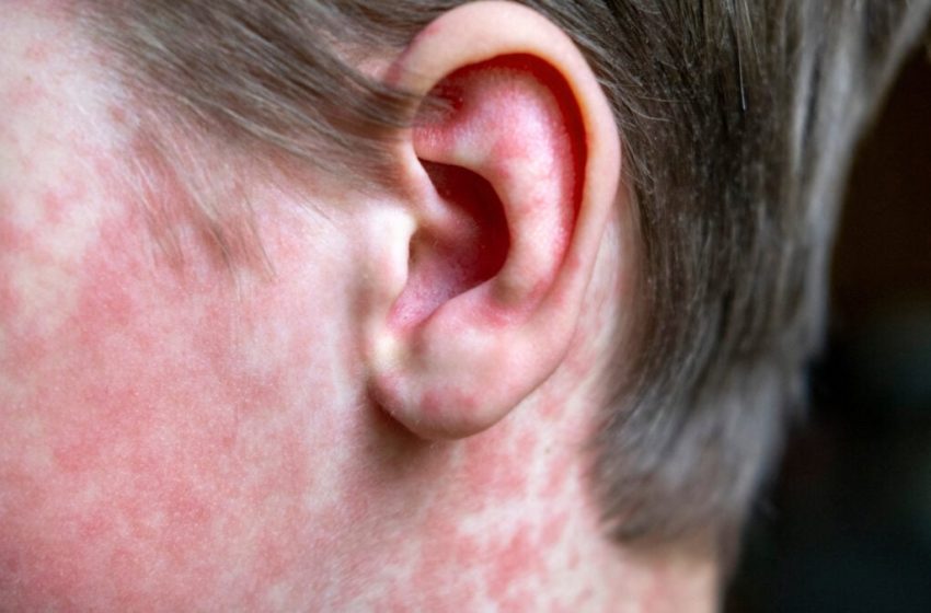  CDC Refuses to Take Blame for Measles Spiraling out of Control