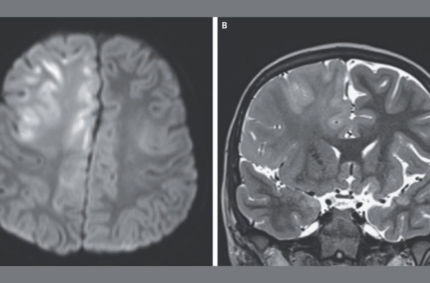  This Is What a Brain Destroyed by Measles Looks Like