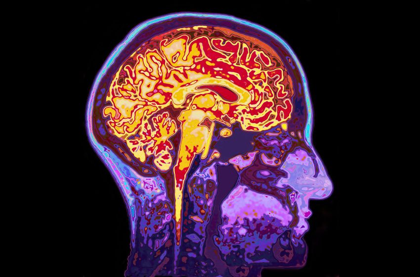  Microplastic accumulation found in brains of dementia patients