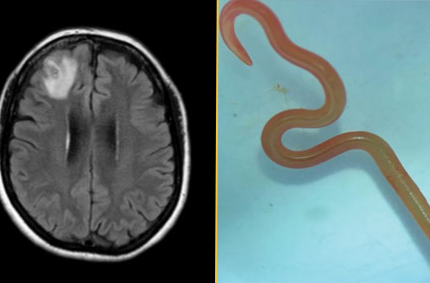  Diagnostic dilemma: A parasite never before seen in humans was behind a woman’s lung infection, organ damage and forgetfulness