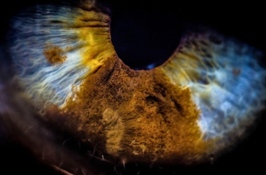  Common Eye Bacteria Linked to Faster Dementia and Alzheimer’s Progression