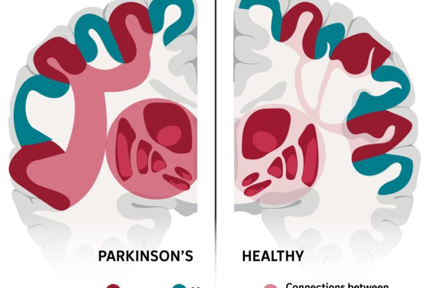  This complex brain network may explain many of Parkinson’s stranger symptoms : NPR