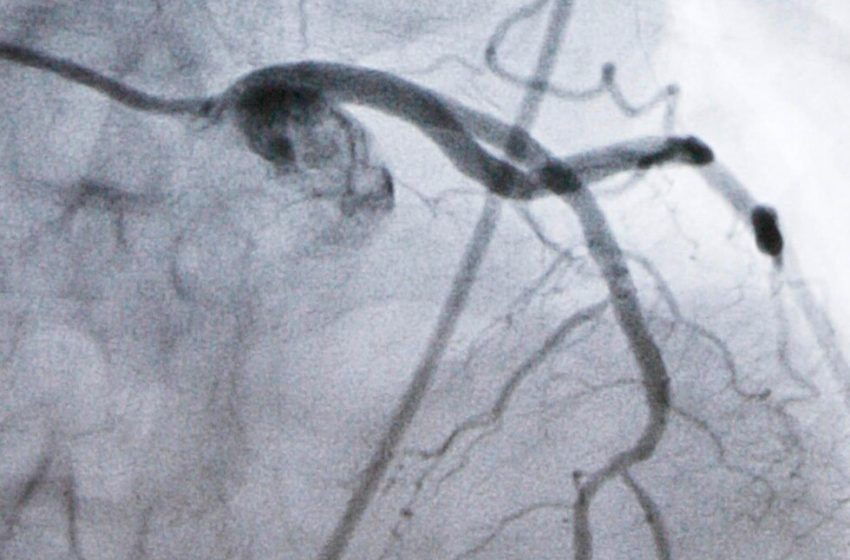  Merck’s experimental pill enlicitide sharply lowered cholesterol in a large study