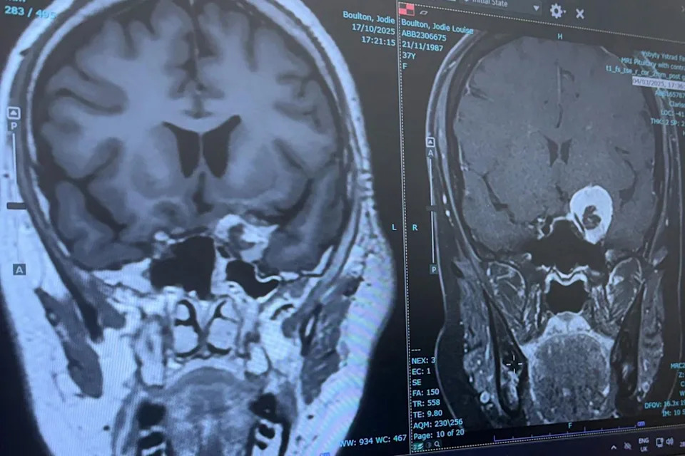 Jodie Boulton's Brain scanCredit: Jodie Boulton/Brain Tumour Research