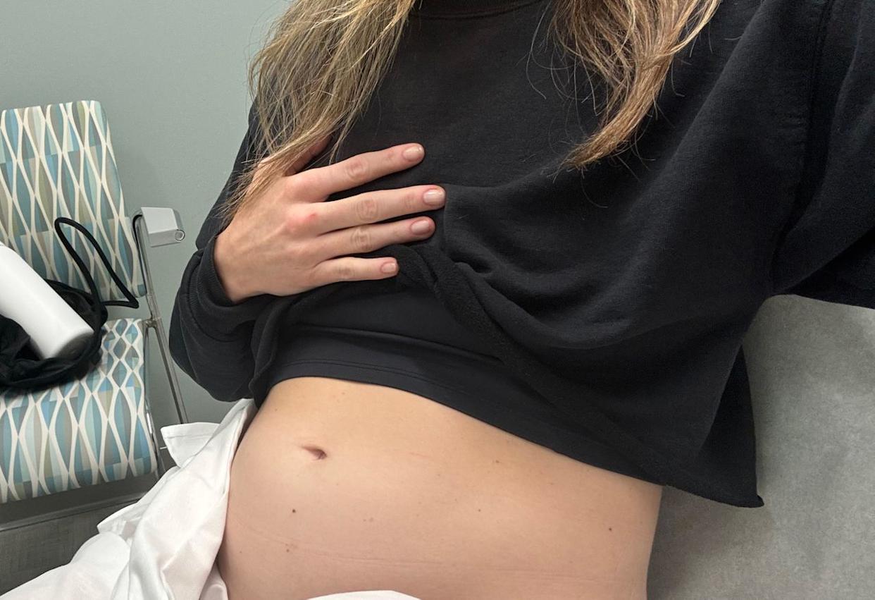 Melissa Diamond's stomach as she dealt with her health issues.Credit: Melissa Diamond