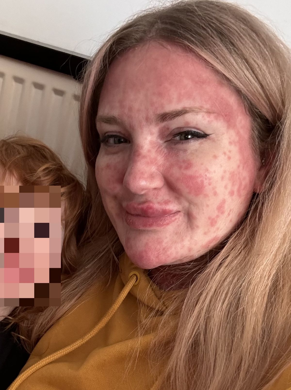 Jayne Walmsley showing the severe measles rash covering her face