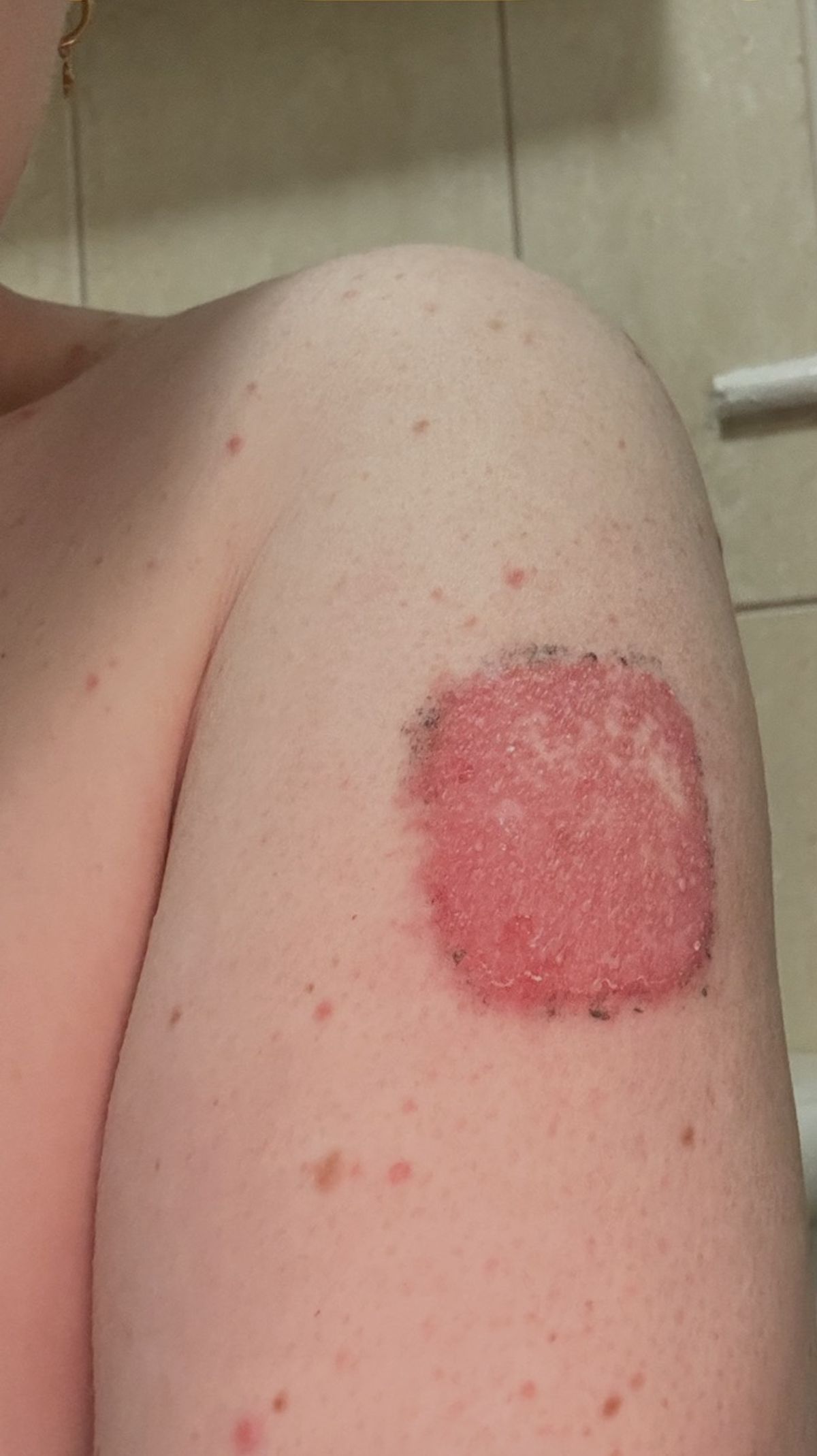 A severe patch of irritated skin on Jayne Walmsley's arm caused by measles