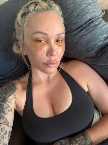 Bunnie Xo reveals bruised appearance following new faceliftCredit: Bunnie Xo/Instagram