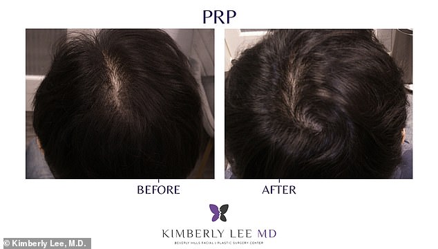 Before and after PRP done by Dr Kimberly Lee