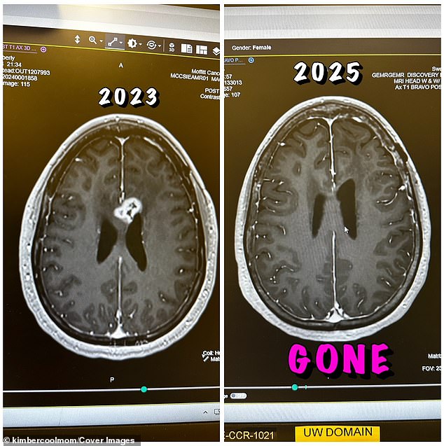 In 2025, doctors took a scan of Pelling's brain. After being told she had months to live, Kimberly heard that she had no evidence of cancer