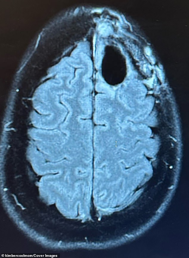 The aggressive, typically incurable tumor [the black patch] was identified in 2022. The cancer attacks the brain's support cells, often in the frontal lobe, stealing concentration, memory and altering personality