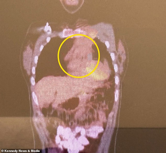 The circle shows the 'grapefruit-sized' tumor in Sadowski's chest